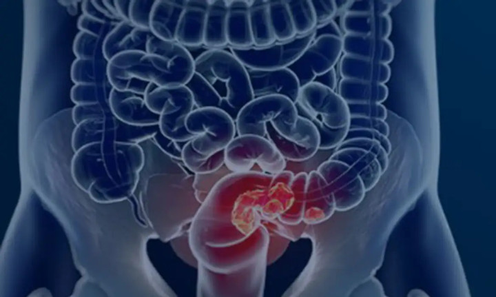 Demora no diagnóstico, dificulta cura do câncer em 60% dos casos