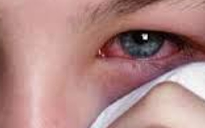 Surto de herpes zoster preocupa medicina dos olhos 